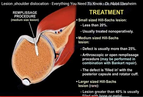 Hill Sach’s lesion — OrthopaedicPrinciples.com