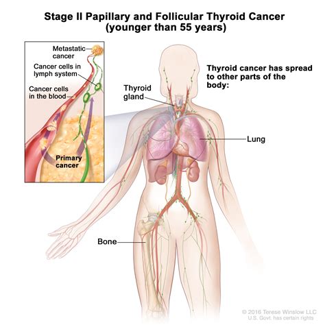 Thyroid Cancer | UCSF Department of Surgery