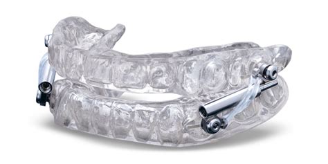 Silent Nite with Glidewell Hinge — Oral Appliance for Sleep Apnea