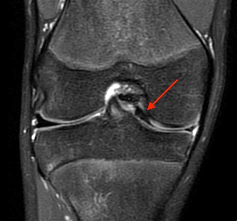 Bucket-handle Tear of the Meniscus | Radsource