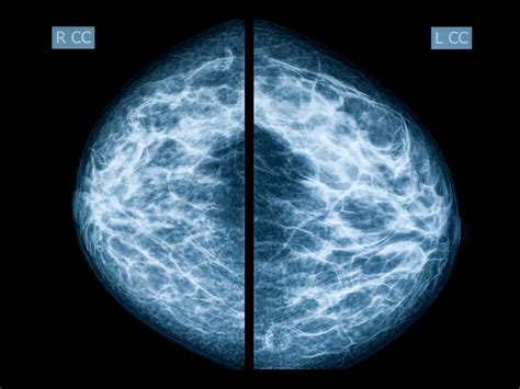 Abnormal Mammogram? 7 Questions to Ask Your Doctor | The Healthy