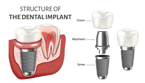 Is a Dental Implant and Crown Right For You? Learn Here