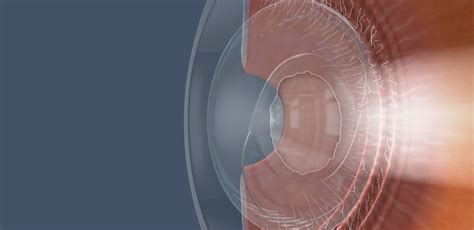 Posterior Capsulotomy - Improve Your Vision After Cataract Surgery