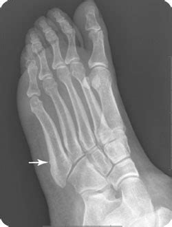 Fifth Metatarsal Fractures | Radiology Key