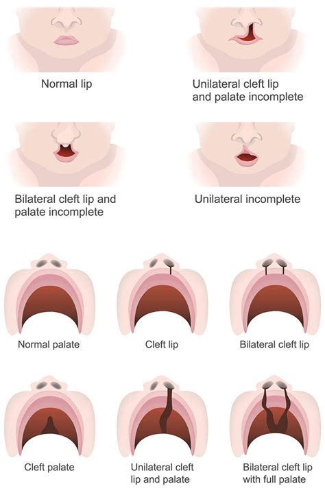 Cleft Lip