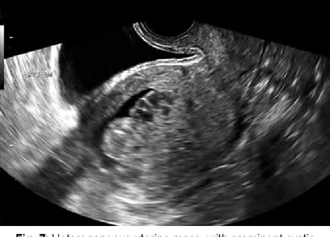 Figure 1 from Ultrasound Imaging of Postpartum Hemorrhage | Semantic ...