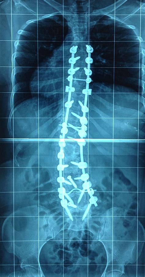 Post-surgical Scoliosis - Scoliosis Physiotherapy