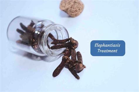 Elephantiasis-Treatment - Ayurvedum