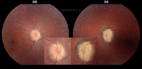 Atlas Entry - Optic Disc Drusen