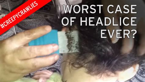 Watch: Is this the worst case of head lice ever? Video shows ...