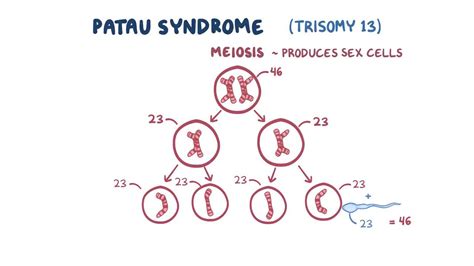 Patau syndrome (Trisomy 13): Video & Anatomy | Osmosis