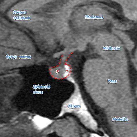 Pituitary MRI (an approach) | Radiology Reference Article | Radiopaedia ...