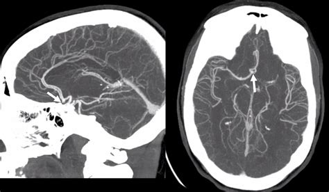 Tiny ACOM Aneurysm Coiling — Expanding Range of Endovascular Treatment ...