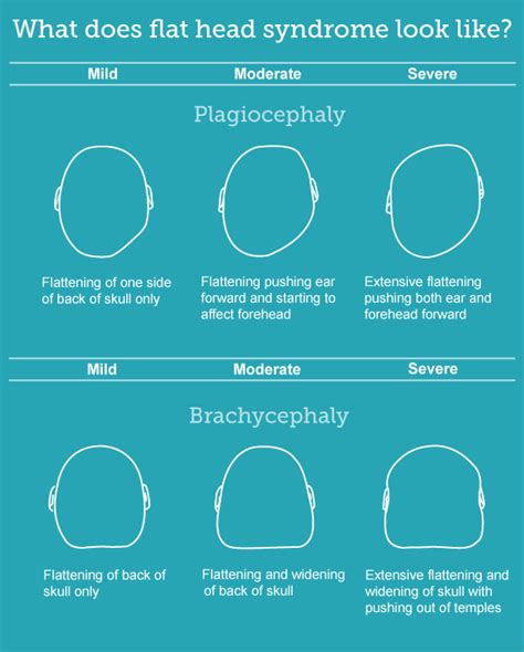 Plagiocephaly and brachycephaly (flat head syndrome) | Flat head ...