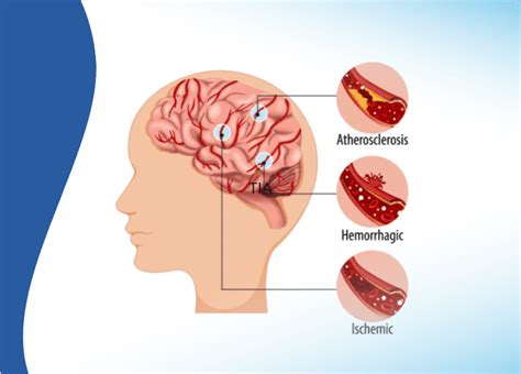 Brain Stroke: Warning Signs, Symptoms, and Prevention