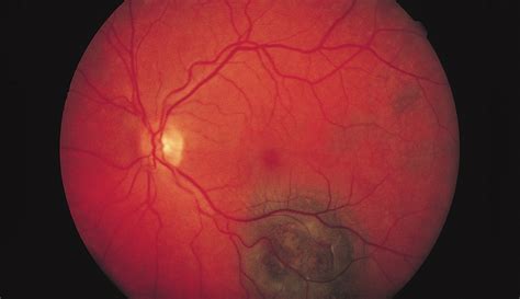 Mushroom-Shaped Choroidal Melanocytoma Mimicking Malignant Melanoma ...