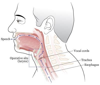 Laryngectomy Anatomy