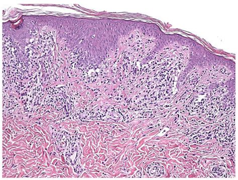 Dermatopathology | Free Full-Text | Annular Lichenoid Dermatitis (of Youth)