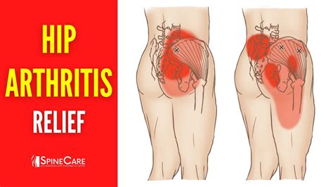 How to Relieve Hip Arthritis Pain in 30 SECONDS - YouTube