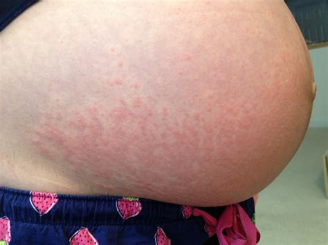 Pruritic Urticarial Papules and Plaques of Pregnancy (PUPPP Rash)