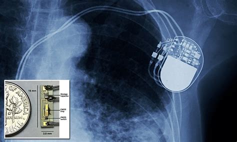 Battery-less pacemaker to end battery replacement surgery | Daily Mail ...