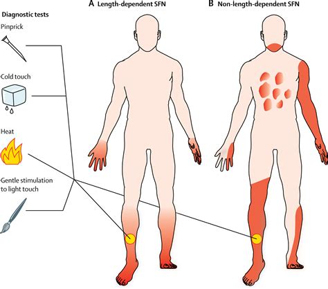 The diagnostic challenge of small fibre neuropathy: clinical ...