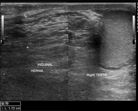 Scrotal Hernia Ultrasound