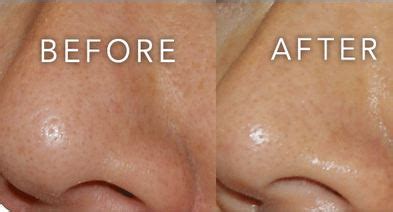 How to Clear Pores on Nose, Face, Clear Clogged Pores at Home Naturally