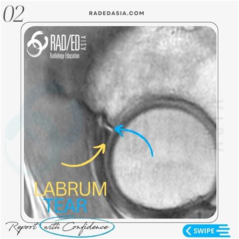 HIP LABRUM LABRAL TEAR MRI RADIOLOGY - Radedasia