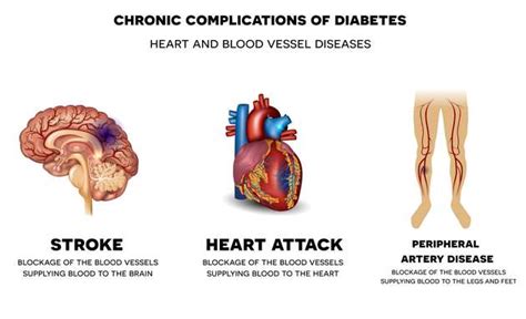 The Link Between Diabetes And Heart Disease | Medanta