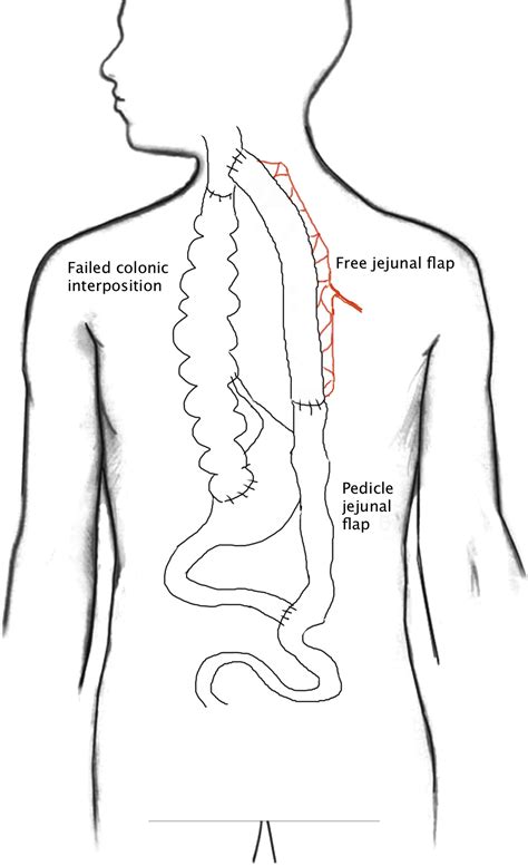 2-Stage free and pedicle jejunum for esophageal replacement after ...