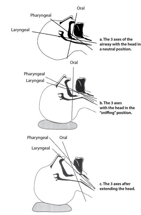 Intubation Step By Step, intubation technique explained