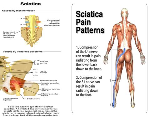 India - a Tourists paradise: Sciatica: Causes, Symptoms and Treatments