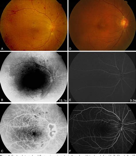 Figure 1 from Ocular Ischemic Syndrome Successfully Treated With ...