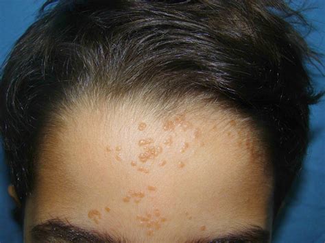 Photos of Warts on Face ~ How To Remove Moles, Warts, Skin Tags Safely