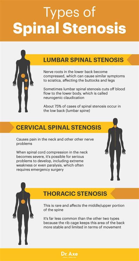 Spinal Stenosis Symptoms Of Spinal Stenosis | Hot Sex Picture