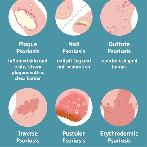 Psoriasis | Chronic Skin Disease | Seattle Dermatology