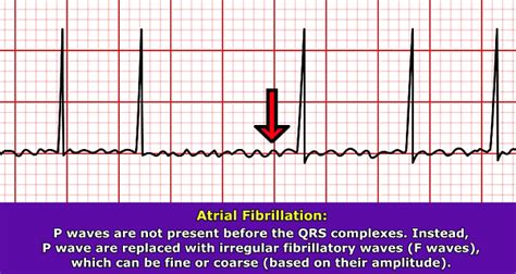 Understanding The EKG Signal Atrial Fibrillation: Resources, 56% OFF