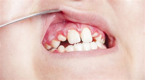 All You Need To Know About Gingivitis Stomatitis | myselfcare.org