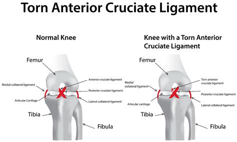 Football Knee Injuries