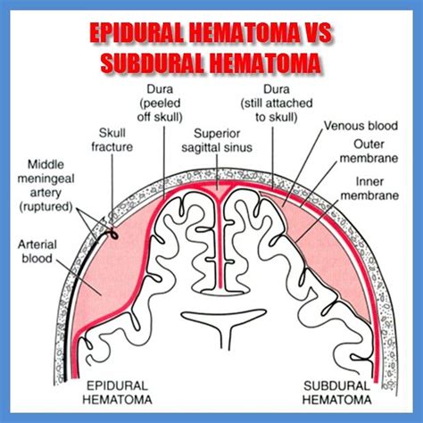 Epidural vs subdural | Medical visual aids | Pinterest | Medical ...