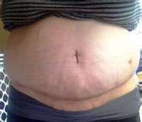 Swelling 6 weeks after tummy tuck » Tummy Tuck: Prices, Photos, Reviews ...