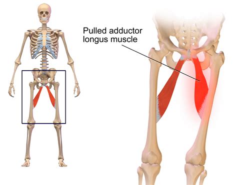 Pérégrination Vide Tombeau pulled groin muscle pain Se ruiner outre le ...