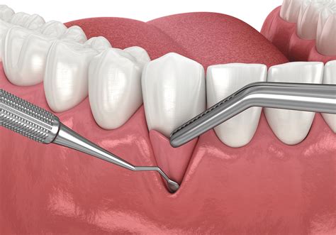 Gum Grafts - Winter Dental