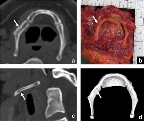 Hyoid fracture (arrow) diagnosed by CT using multiplanar... | Download ...