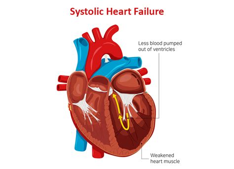 What ar Systolic Heart Failure Symptoms and Treatment | Dr. Raghu