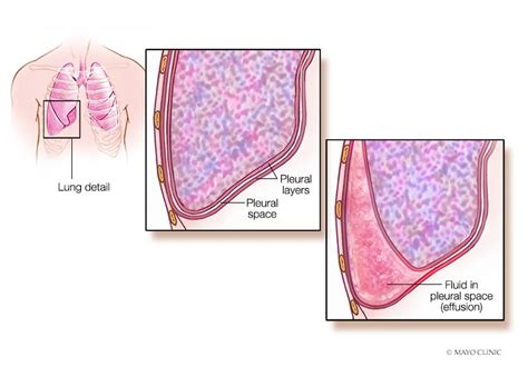 Update in pleural disease - Mayo Clinic