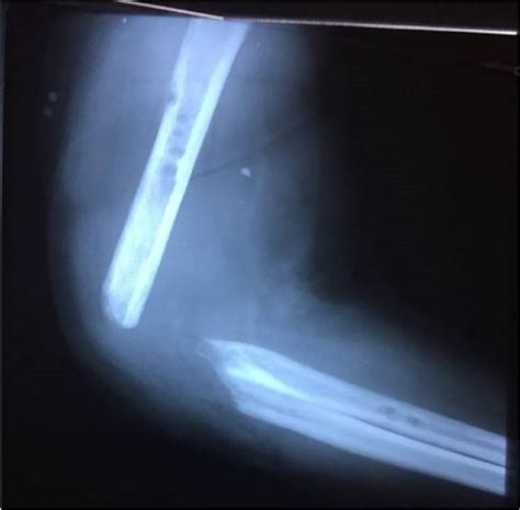 Radiographic view after removing the external fixator. | Download ...