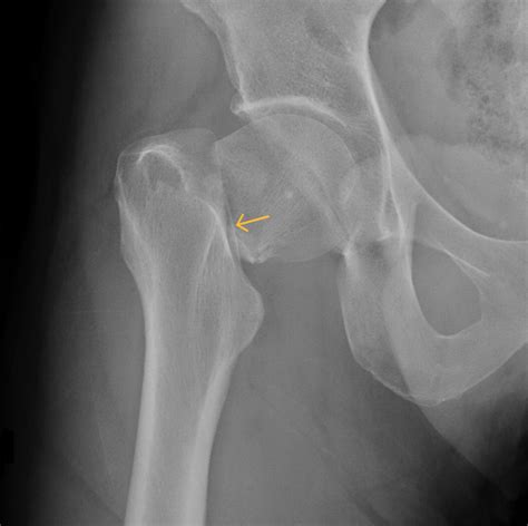 Five questions to ask a doctor about your hip fracture