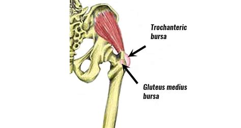 Anterior Hip Bursitis